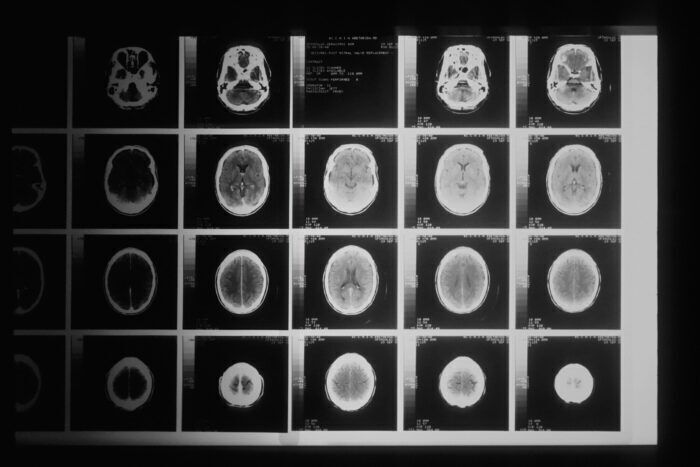 Sviluppata una nuova terapia che utilizza semi magnetici per riscaldare e uccidere il cancro