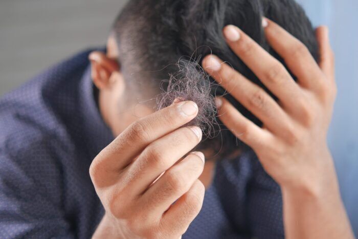 Alopecia: come affrontare stigma sociale dalle conseguenze psicologiche gravi