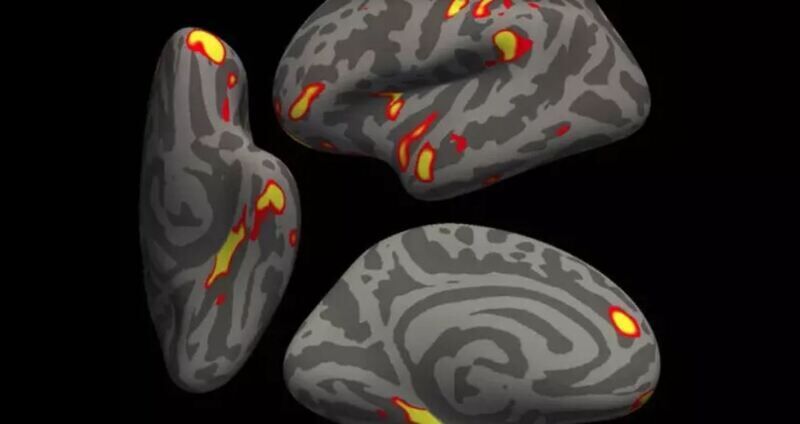 Infezione da Covid-19 collegata al restringimento del cervello e al declino cognitivo
