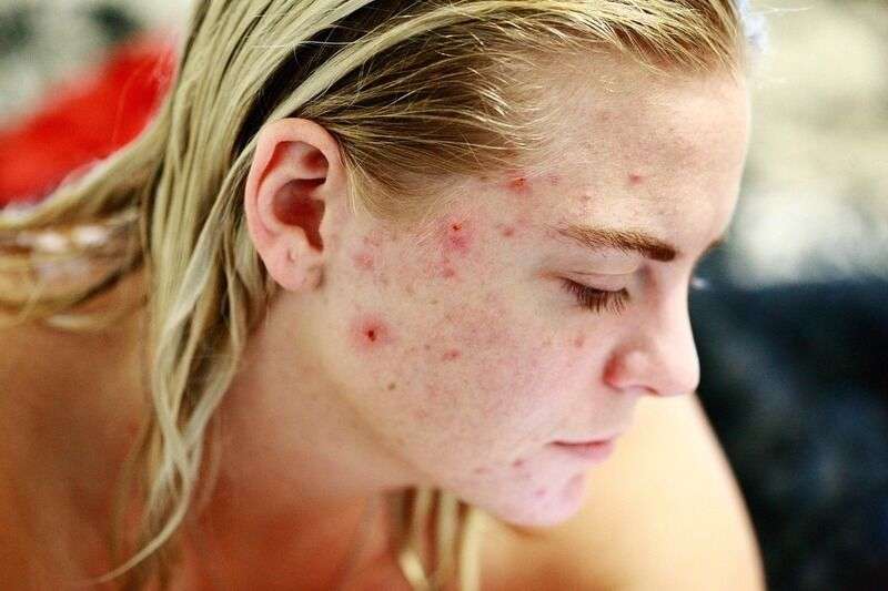 L’influenza del sole sull’acne: benefici e precauzioni