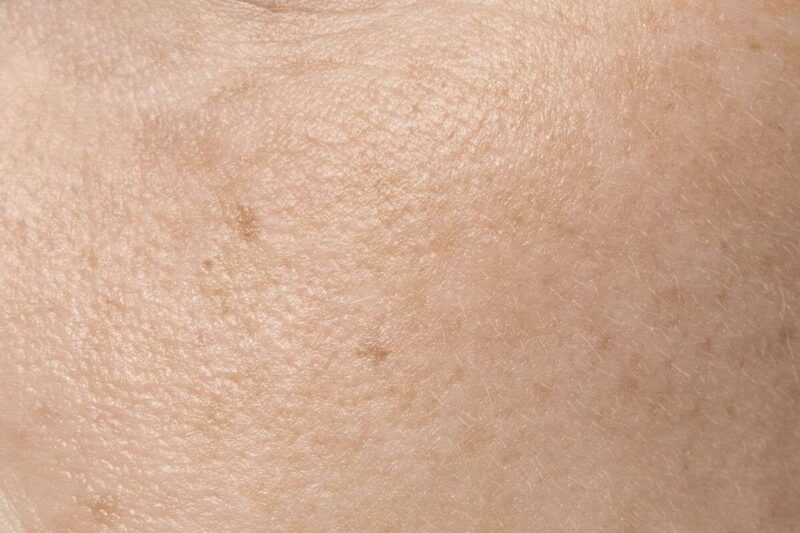 Xerosi: pelle secca su viso e corpo, cause e rimedi