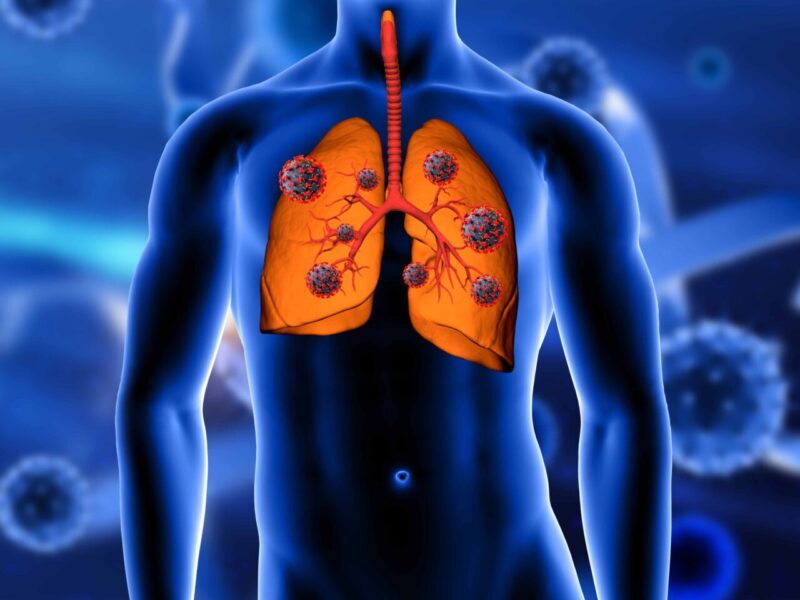 Franco Di Mare, Mesotelioma: Sintomi, Cause e Trattamenti Legati all’Esposizione all’Amianto
