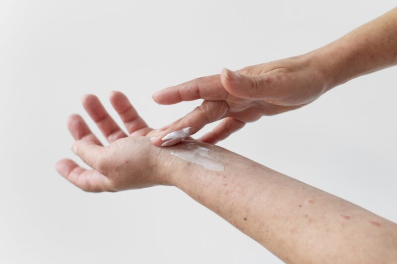 Dermatite seborroica: rimedi contro il prurito intenso