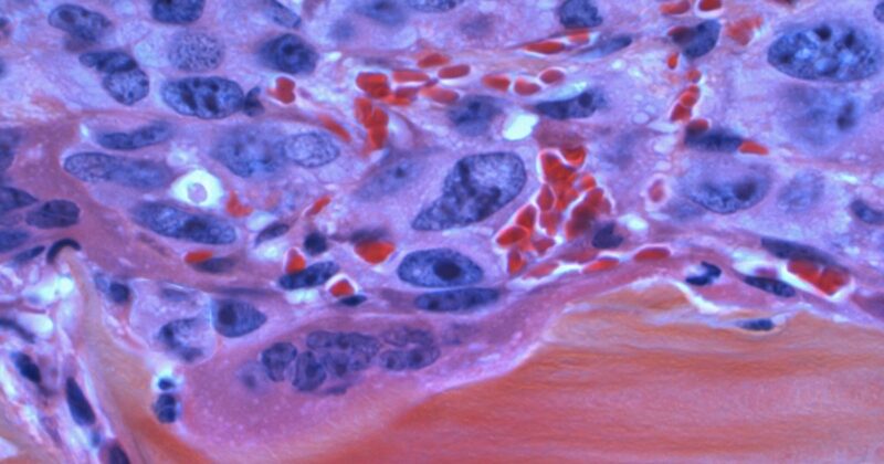 Cancro al pene: i casi sono in aumento in tutto il mondo