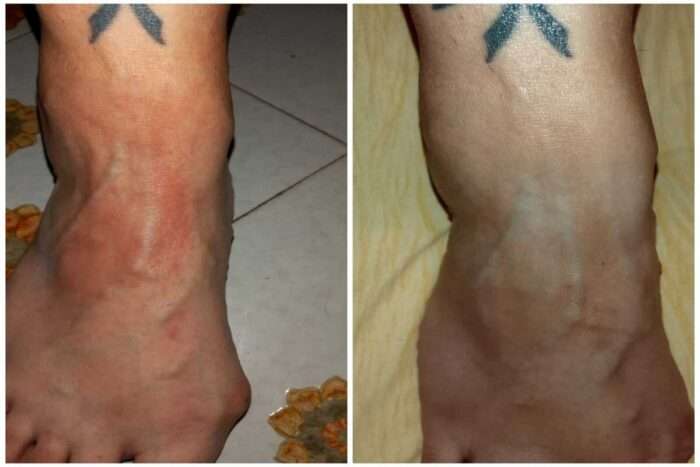 Artrite psoriasica malattia infiammatoria