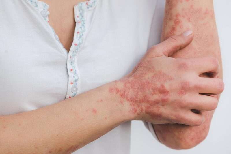 Artrite psoriasica: cos’è, sintomi e nuove terapie per una malattia infiammatoria spesso sottovalutata