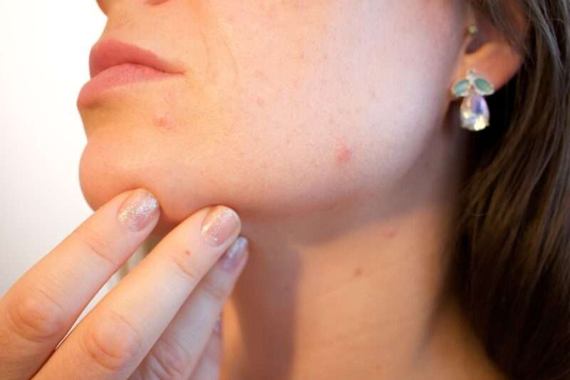Acne in estate: perché il sole non la cura e può peggiorarla