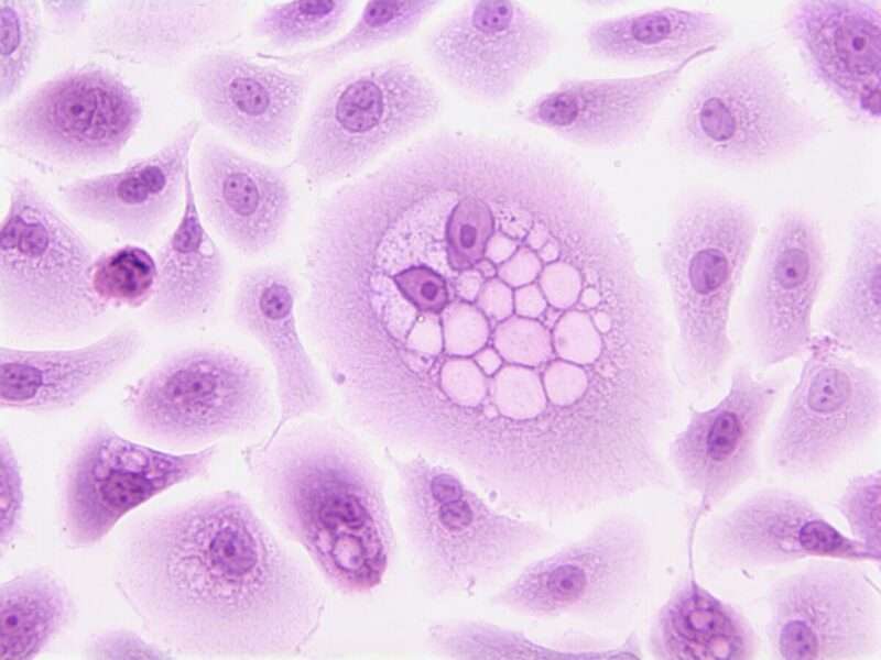 Elevato consumo di fruttosio e rischio di cancro al pancreas: cosa rivela lo studio