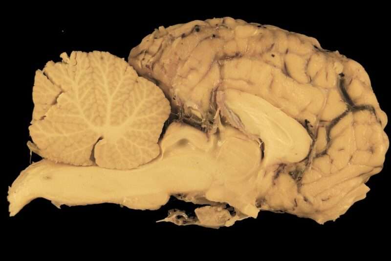 Un semplice mix di integratori potrebbe aiutare nelle terapie per il cancro al cervello