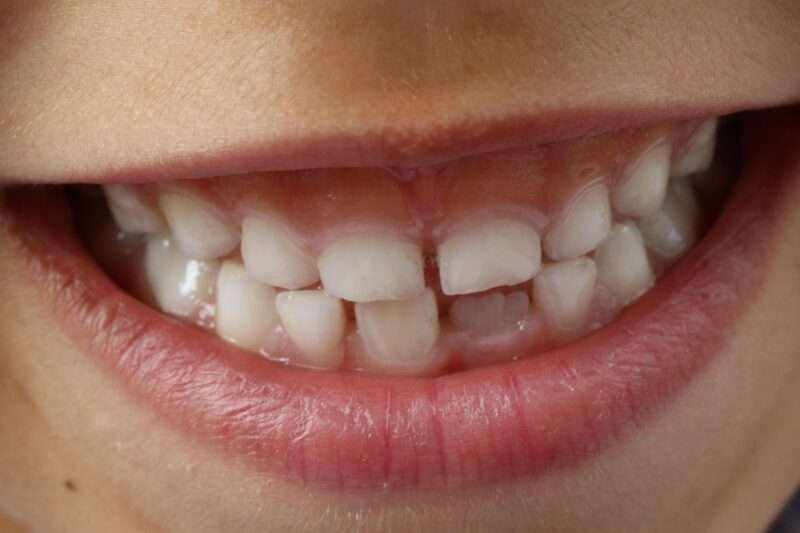 3 segnali nascosti del bruxismo e cosa fare per proteggere i denti