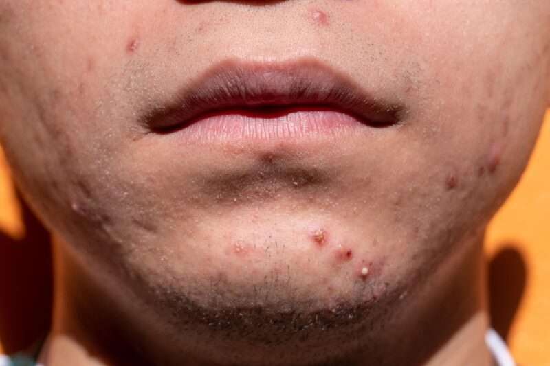 Cerotti a microaghi: la nuova frontiera contro l’acne