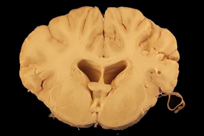 Declino cognitivo e intestino: il legame scoperto tra microbiota e cervello