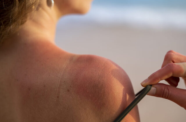 Una sola scottatura solare grave può lasciare danni permanenti: cosa succede alla pelle