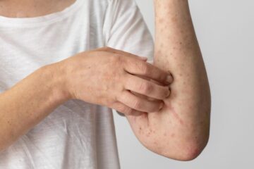 Mpox torna a circolare in Italia: cosa sta succedendo e chi è davvero a rischio